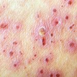 Herpes Zoster (Shingles) – after treatment