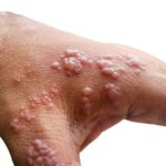 Skin infected Herpes zoster virus on the arms